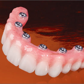 Dental Implant