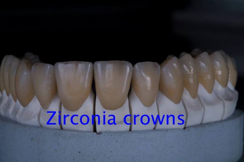 zirconia crown & bridges