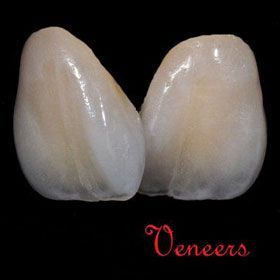 Dental Veneers